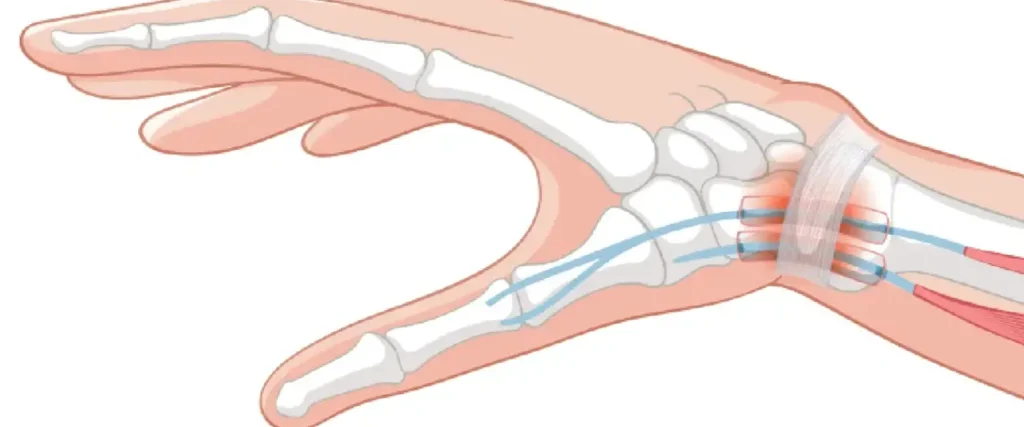 Carpal Tunnel Syndrome